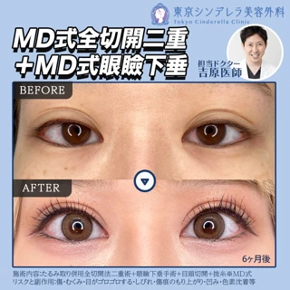 MD式全切開二重＋MD式眼瞼下垂《麻酔代込》最強目ヂカラセット◎
