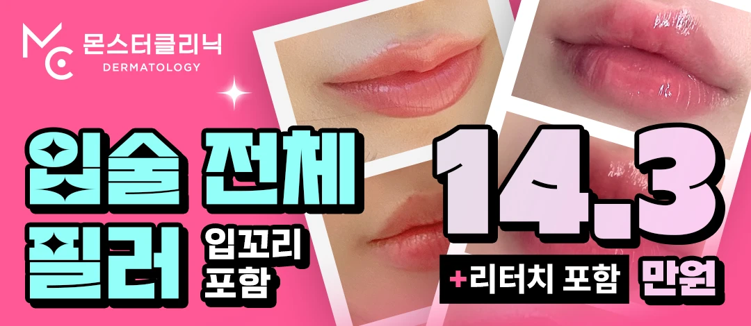 입술 입꼬리 전체필러 뀨x by 몬스터의원 | 강남언니 - 1등 성형수술&피부시술 정보앱