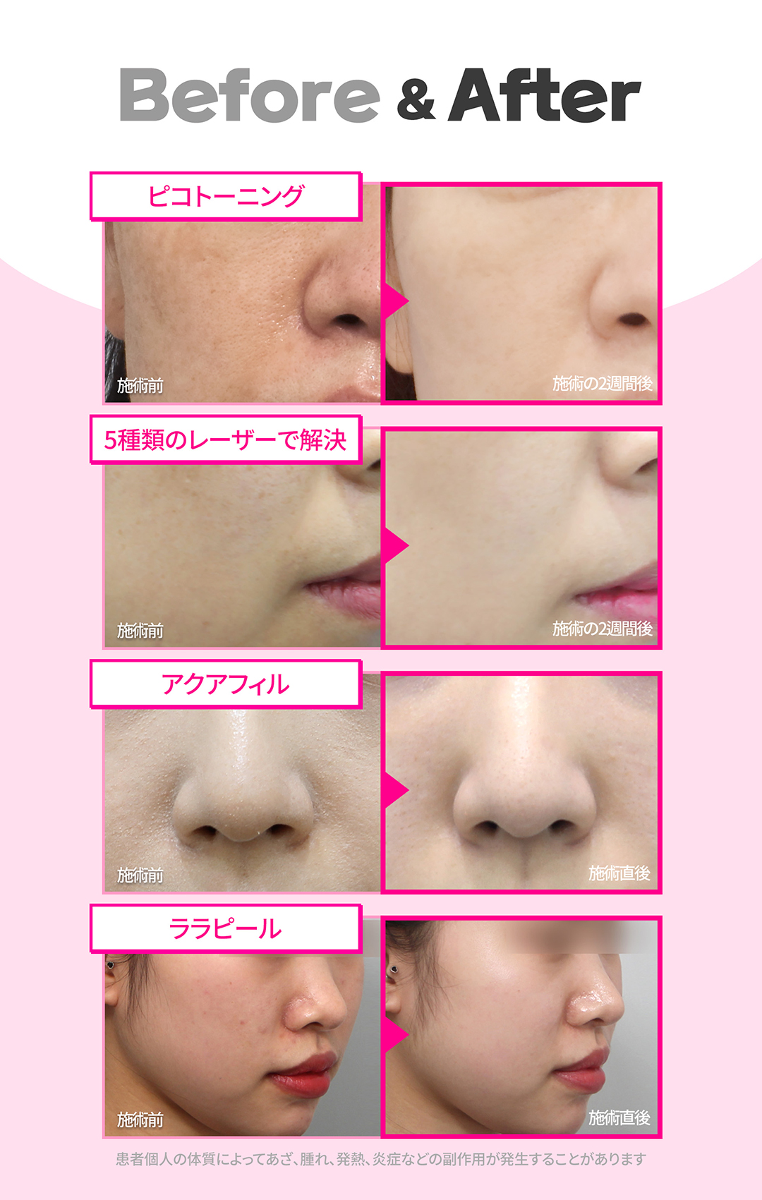 気になるくすみ、そばかすなどの色素治療に!
美白ピコトーニング&選んで受ける肌管理
-ピコトーニングで正確に色素分子だけを破壊し周辺組織のダメージを軽減
-痛みとダウンタイムは少なく、効果はUP
-肌の状態やお悩みに合った管理でシナジー効果