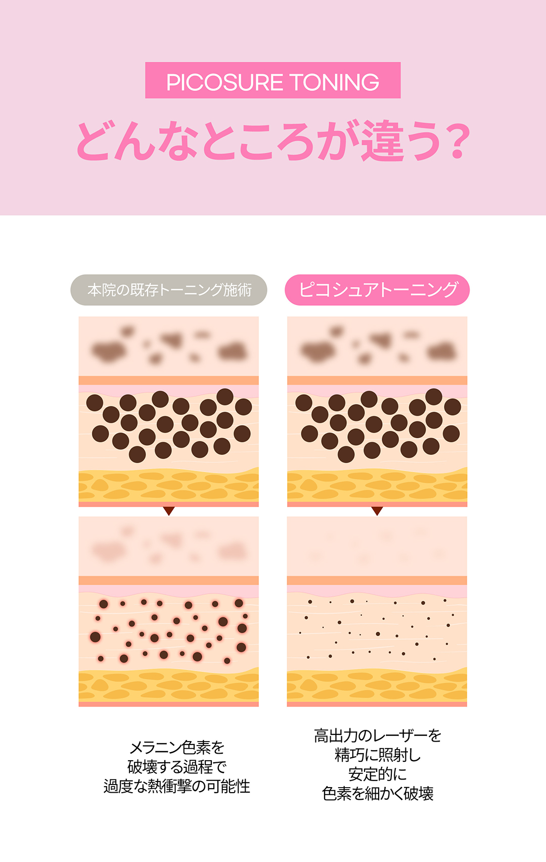 気になるくすみ、そばかすなどの色素治療に！ 
美白ピコトーニング&選んで受ける肌管理

－ピコトーニングで正確に色素分子だけを破壊し周辺組織のダメージを軽減
－痛みとダウンタイムは少なく、効果はUP
－肌の状態やお悩みに合った管理でシナジー効果