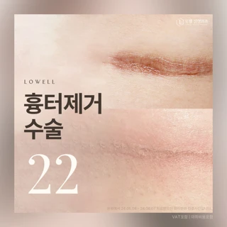 로웰_흉터제거수술