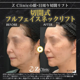 【モニター】切開式フルフェイスネックリフト