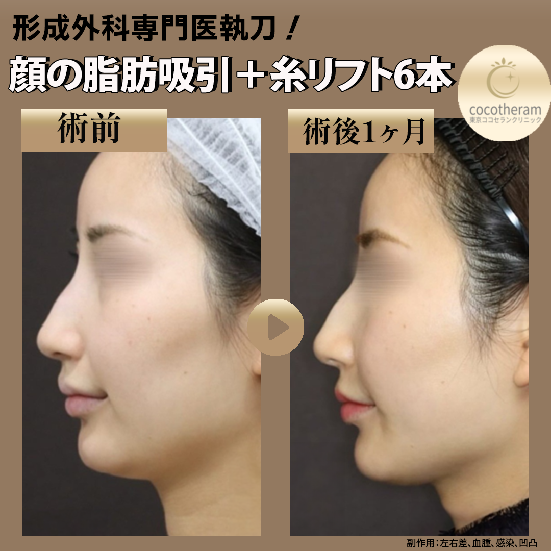 【2枚セット】湘南美容外科 SBC 脂肪吸引 ボレロ L 湘南美容外科脂肪吸引二の腕ボレロ2枚 整形 痩せる｜レディース