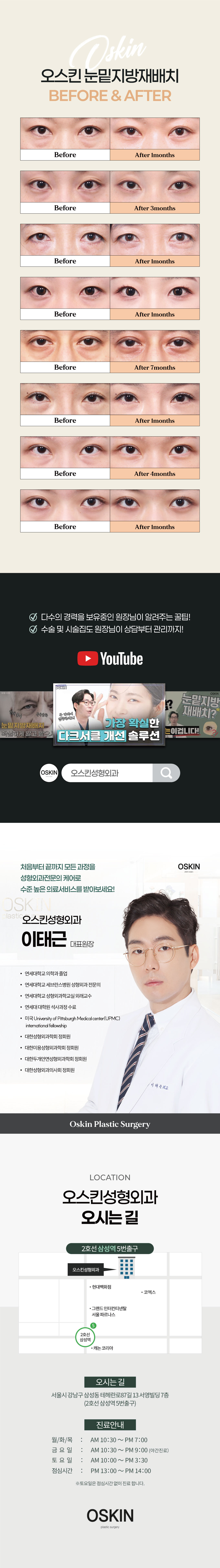 독보적인 후기가 증명하는 오스킨성형외과의 눈밑지방재배치
눈밑 유형을 정확히 판단하여 개개인 눈에 따른 수술플랜으로 눈밑을 환하게 해주는 오스킨 눈밑지방재배치