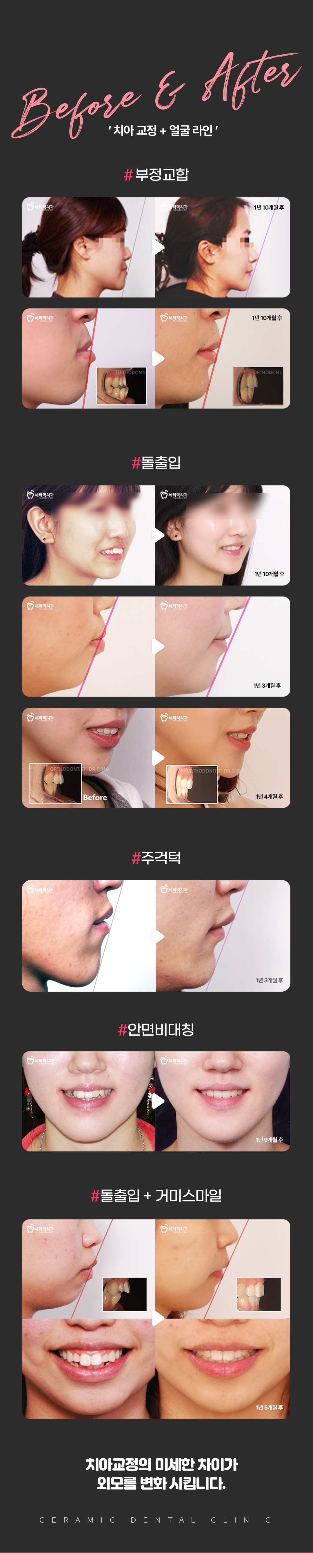 돌출입 / 부정교합 / 주걱턱 / 안면비대칭 수술 없는 뷰티 교정