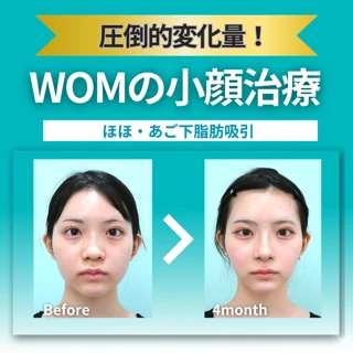 ベイザー脂肪吸引(頬+あご下)|圧迫24hのみでOK|口コミで話題!顎下ペラペラ