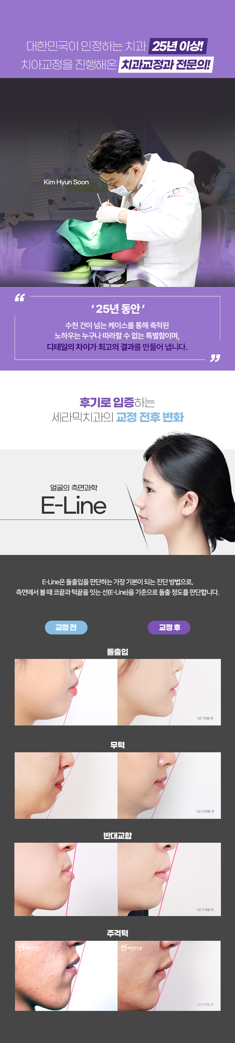 미국 3M사의 심미성이 뛰어난 세라믹 브라켓