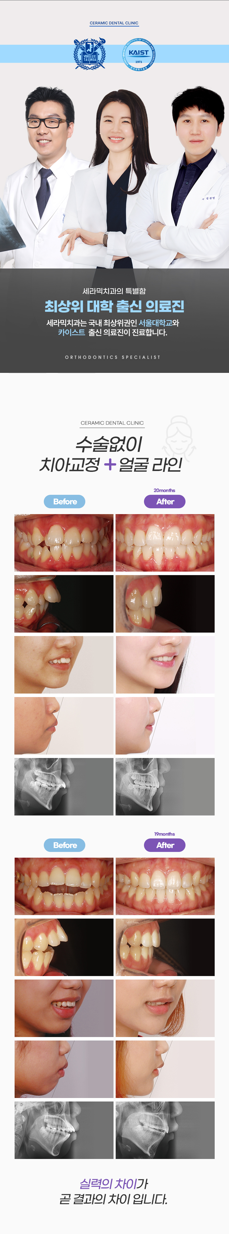 미국 3M사의 심미성이 뛰어난 세라믹 브라켓