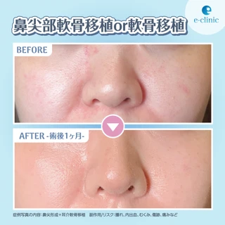 【保証付き】鼻尖部軟骨移植 or 軟骨膜移植|相談無料