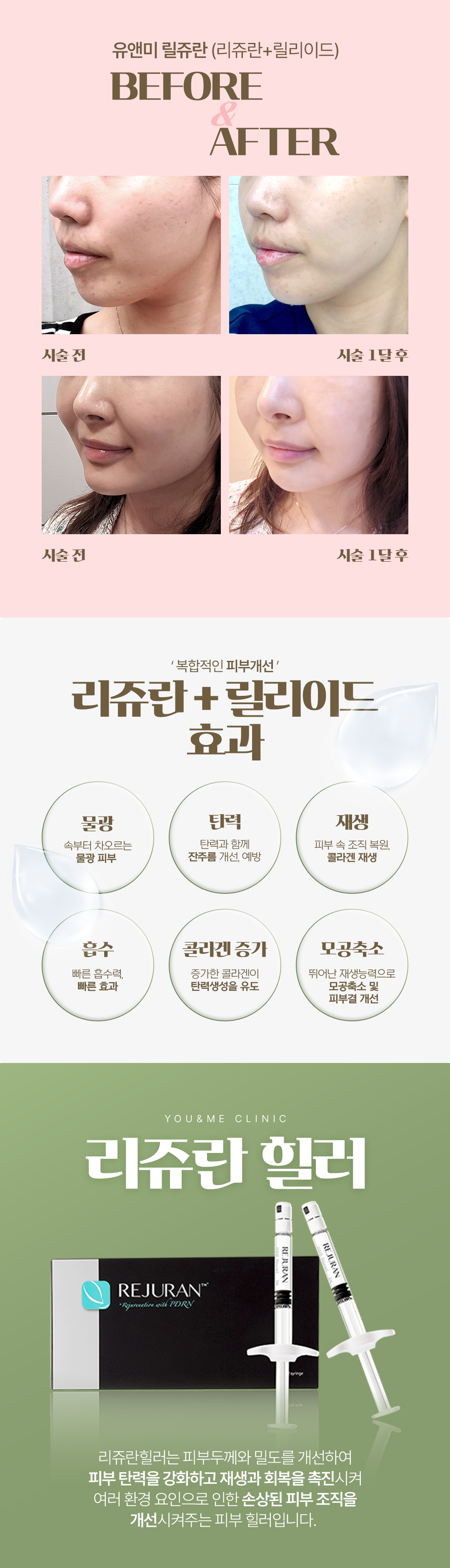 스킨부스터 베스트 두가지를 피부에 채우다,
리쥬란 힐러와 릴리이드가 만나 극대화되는 물광재생효과

즉각적인 보습과 피부 속까지 콜라겐을 채워 탄탄하게 피부코어를 잡아보세요.
6가지 엄격한 제조공정을 거친 안정성을 인증받아 흡수력이 빠르고 다운타임이 적습니다. 