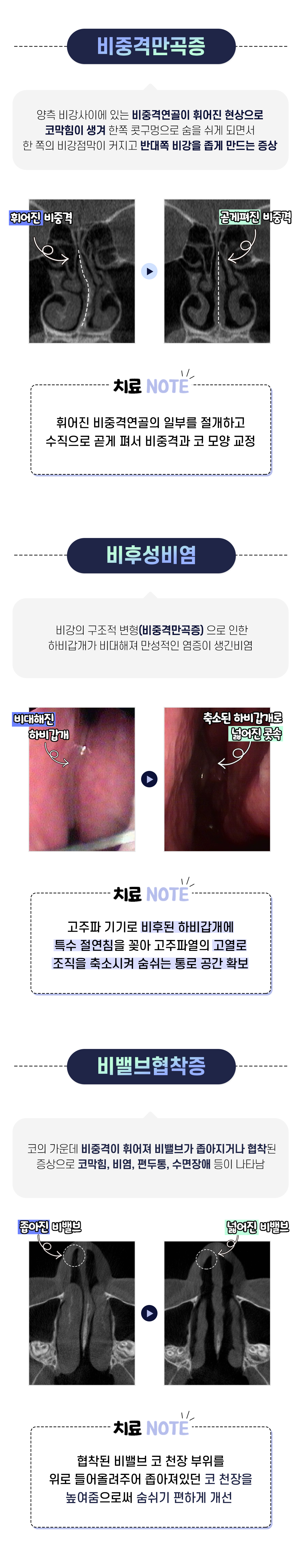 코성형 이벤트_기능코성형, 기능코수술, 코기능교정, 콧대교정, 코끝교정, 비염수술, 남자코, 콧대, 휜코, 매부리코, 코재수술