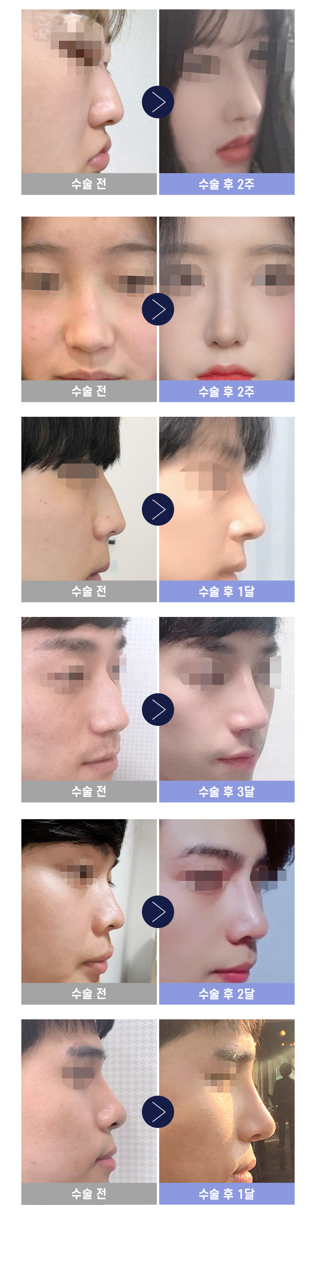 코성형 이벤트_기능코성형, 기능코수술, 코기능교정, 콧대교정, 코끝교정, 비염수술, 남자코, 콧대, 휜코, 매부리코, 코재수술
