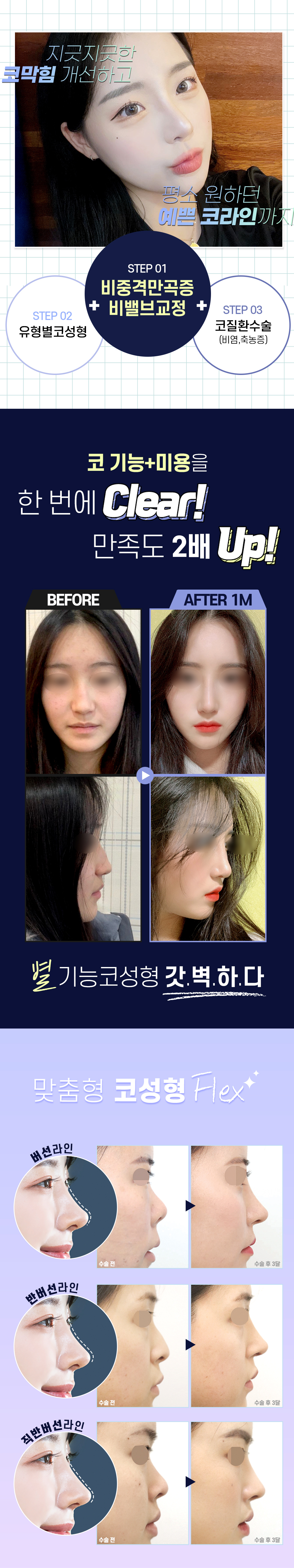 코성형 이벤트_기능코성형, 기능코수술, 코기능교정, 콧대교정, 코끝교정, 비염수술, 남자코, 콧대, 휜코, 매부리코, 코재수술
