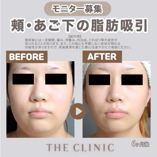 頬・あご下の脂肪吸引モニター