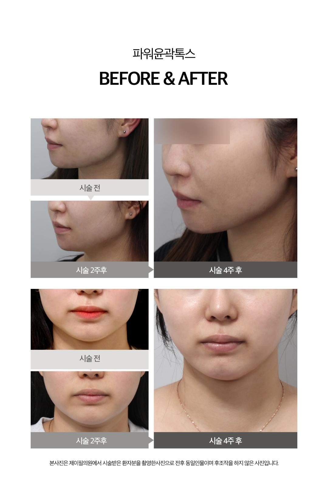 어느각도에서나 예쁘게 얼굴핏 살리는 제이필 파워윤곽톡스
지방분해하고 근육은 정리해서 날렵한 라인만 남기기
정품정량은 기본, 개인별 맞춤시술로 정확한 근육 축소의 턱보톡스와
고농축 지방분해 성분의 주사제를 사용하여 효과적으로 이중턱으로 개선하는 윤곽주사의 조합
- 사각턱축소, 얼굴붓기 감소, 이중턱 개선, 얼굴라인 개선