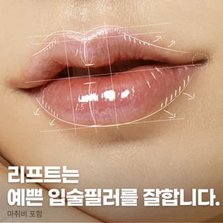 대구입술필러, 입꼬리필러, 가로확장필러, 입술볼륨필러