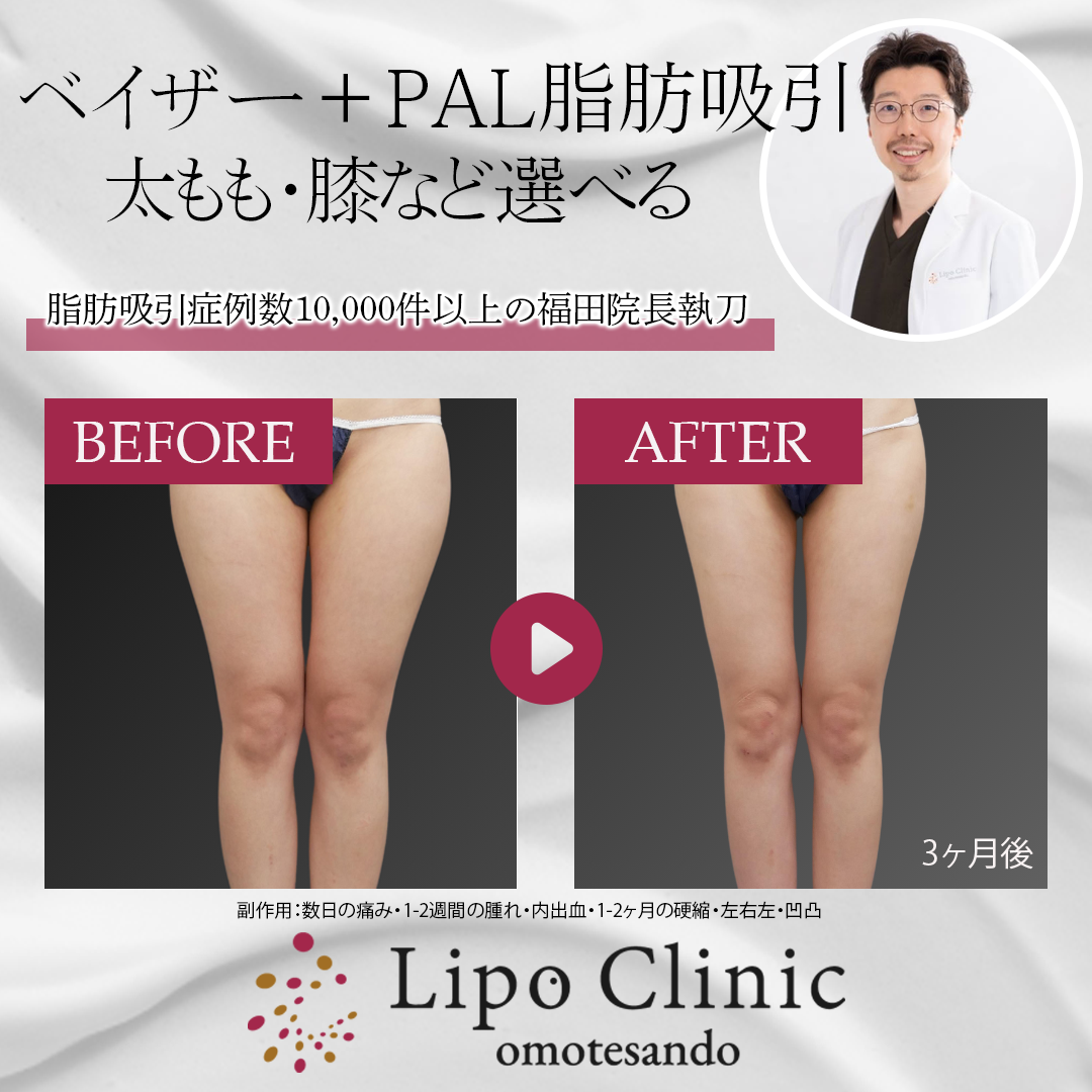 脂肪吸引器 脂肪吸引手術の流れ - 美容外科｜船橋中央クリニック&青山セレスクリニック