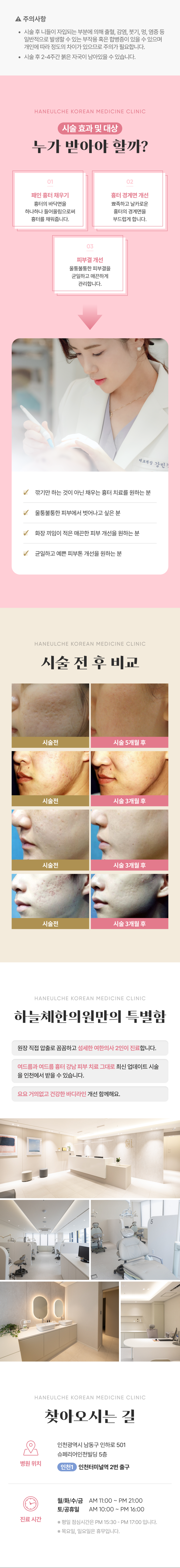  패인 흉터는 반복되는 염증에 의한 피부 손상이 피부가 재생될 수 있는 한계를 넘어설 때 발생합니다. 즉, 손상된 피부가 재생되는 과정 중에 생긴 섬유소가 비정상적으로 엉기면서 피부 표면을 안쪽으로 잡아당기는 섬유밴드를 형성한 결과입니다. 패인 흉터는 일반적인 레이저 시술만으로는 쉽게 호전되지 않습니다.
 레이저 시술의 한계를 보완하기 위해 고안된 시술이 바로 여드름흉터침(새살침)입니다.
새살침은 패인 흉터가 차오를 수 있게 흉터의 표면을 안쪽으로 잡아당기고 있는 섬유밴드를 미세한 침으로 끊어 흉터 아래에 공간을 만들어주고 그 공간에 새살이 차오를 수 있게 도와주는 시술입니다.