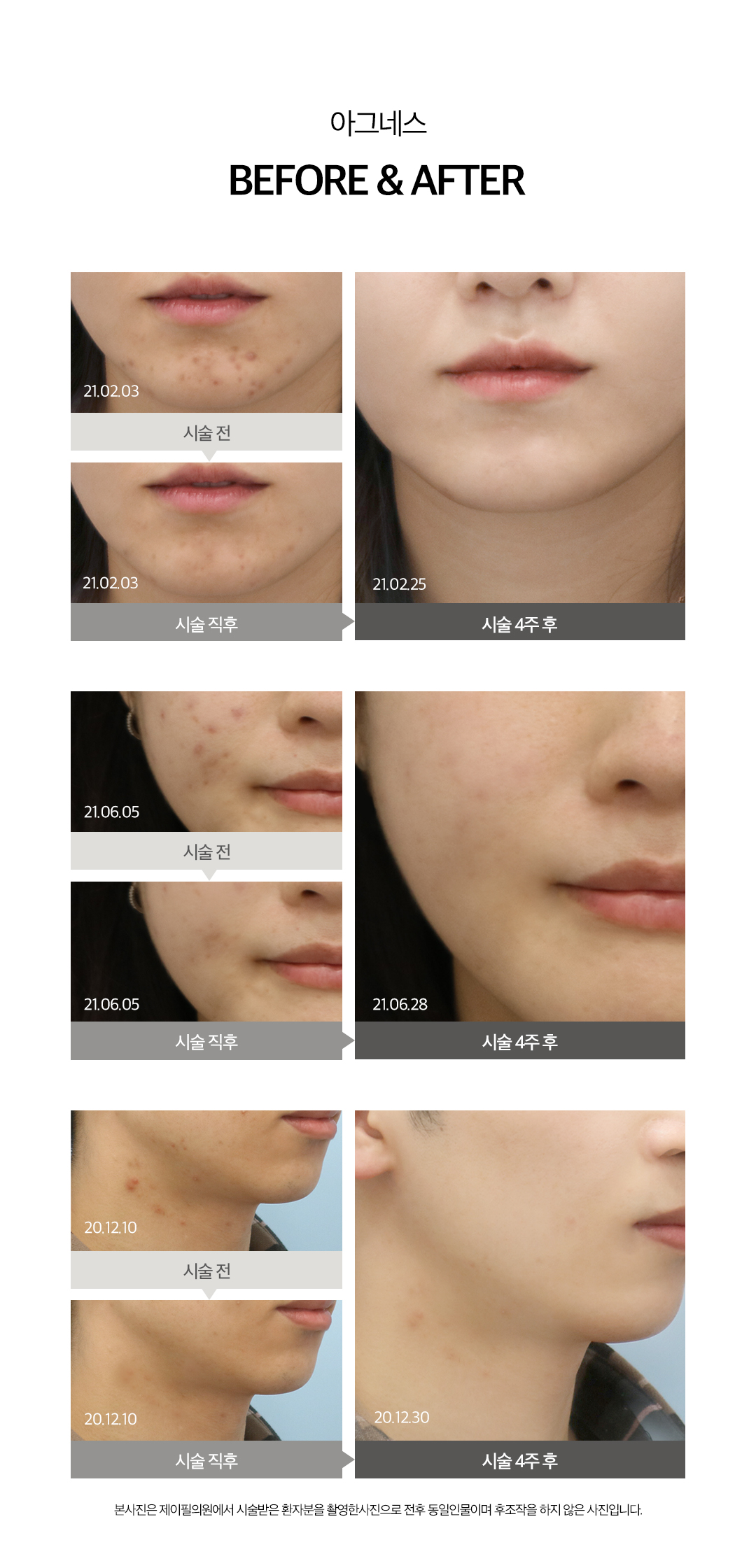 피지선 파괴 레이저 아그네스로 여드름 재발은 STOP
- 피부 표피는 보호하면서 피지선만 선택적으로 파괴하는 치료법
- 파괴된 피지선으로 인해 여드름 발생 가능성 DOWN
- 1~3회 시술로도 만족스러운 효과 얻을 수 있음
- KFDA 및 유럽 CE의 인증을 획득한 장비