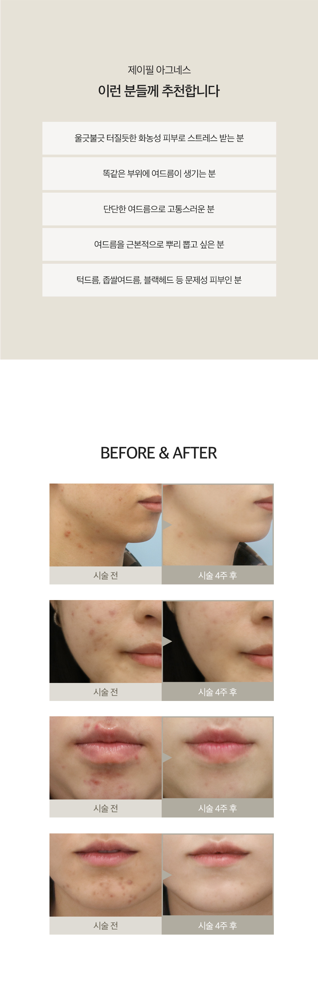 피지선 파괴 레이저 아그네스로 여드름 재발은 STOP
- 피부 표피는 보호하면서 피지선만 선택적으로 파괴하는 치료법
- 파괴된 피지선으로 인해 여드름 발생 가능성 DOWN
- 1~3회 시술로도 만족스러운 효과 얻을 수 있음
- KFDA 및 유럽 CE의 인증을 획득한 장비