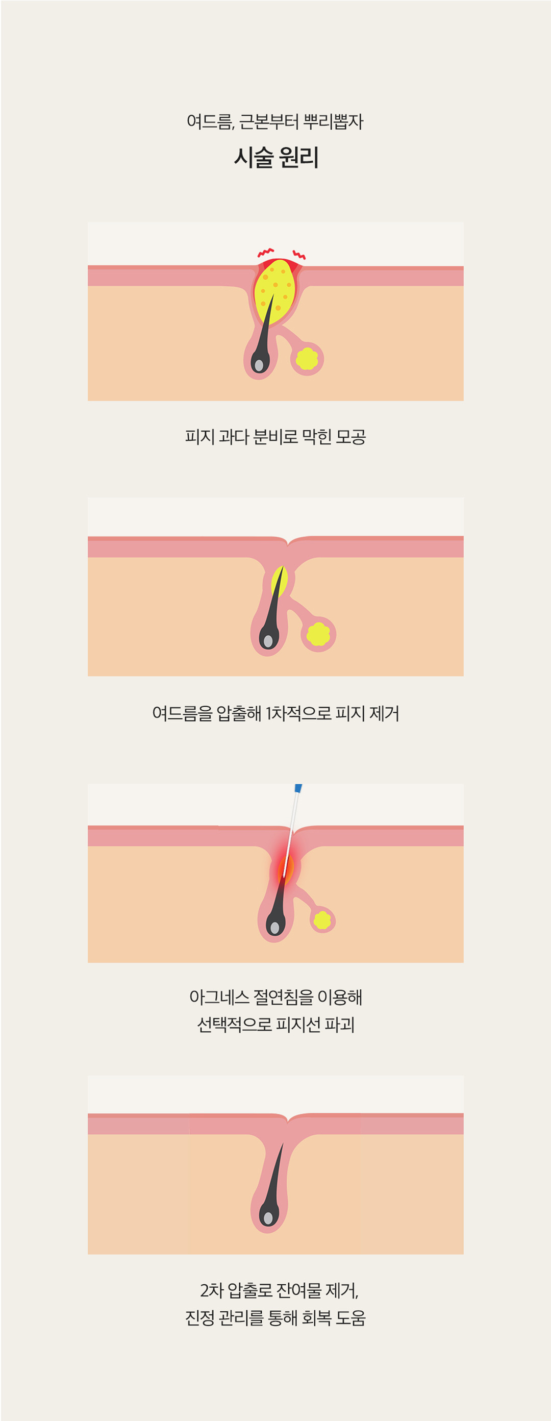 피지선 파괴 레이저 아그네스로 여드름 재발은 STOP
- 피부 표피는 보호하면서 피지선만 선택적으로 파괴하는 치료법
- 파괴된 피지선으로 인해 여드름 발생 가능성 DOWN
- 1~3회 시술로도 만족스러운 효과 얻을 수 있음
- KFDA 및 유럽 CE의 인증을 획득한 장비