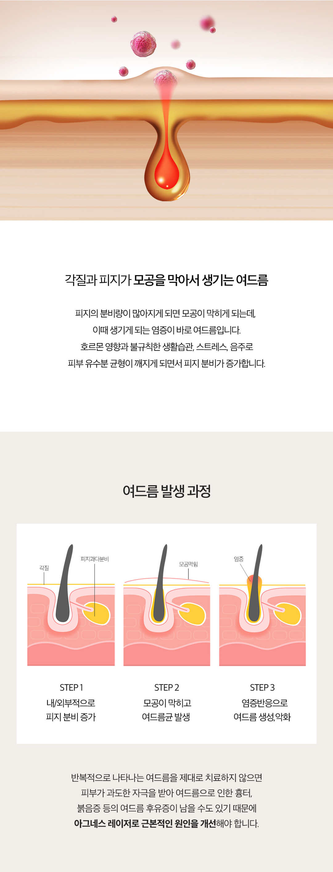 피지선 파괴 레이저 아그네스로 여드름 재발은 STOP
- 피부 표피는 보호하면서 피지선만 선택적으로 파괴하는 치료법
- 파괴된 피지선으로 인해 여드름 발생 가능성 DOWN
- 1~3회 시술로도 만족스러운 효과 얻을 수 있음
- KFDA 및 유럽 CE의 인증을 획득한 장비