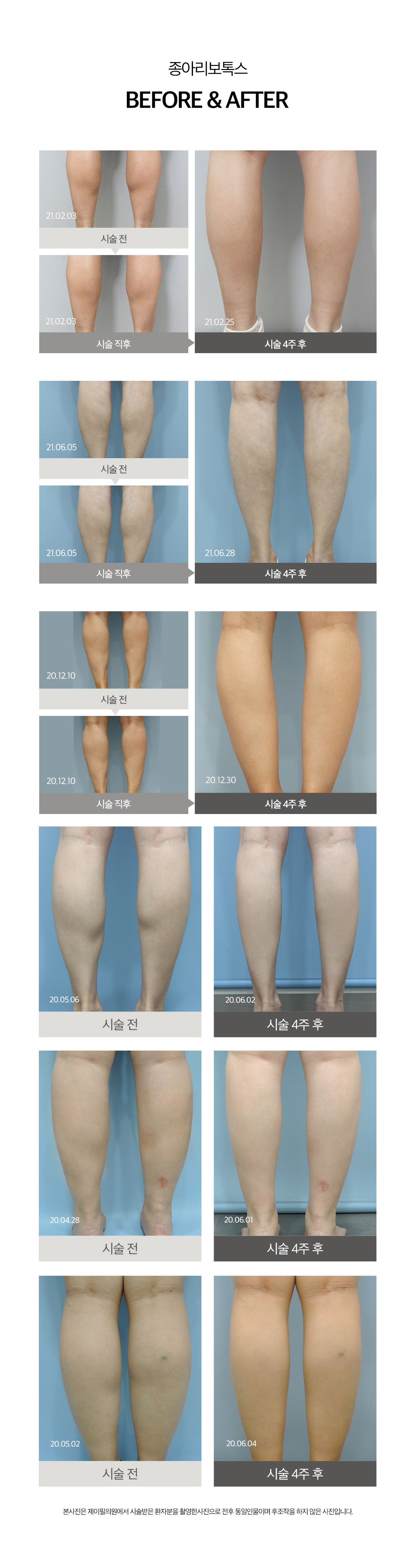 승모근보톡스 , 종아리보톡스로 날씬한 바디라인만들기

종아리보톡스
-다이어트로 빠지지 않았던 종아리알을 수술 없이 빠르게 해결
-가늘고 긴바늘을 사용하며 지방이 펴질 수 있도록 강하게 눌러서 근육까지 주입  

승모근보톡스
-보튤리늄 성분을 승모근에 주입하여 근육을 일시적으로 마비시켜서 승모근 근육 사이즈 축소
-근육으로 인한 통증이나 어깨 비대칭 교정