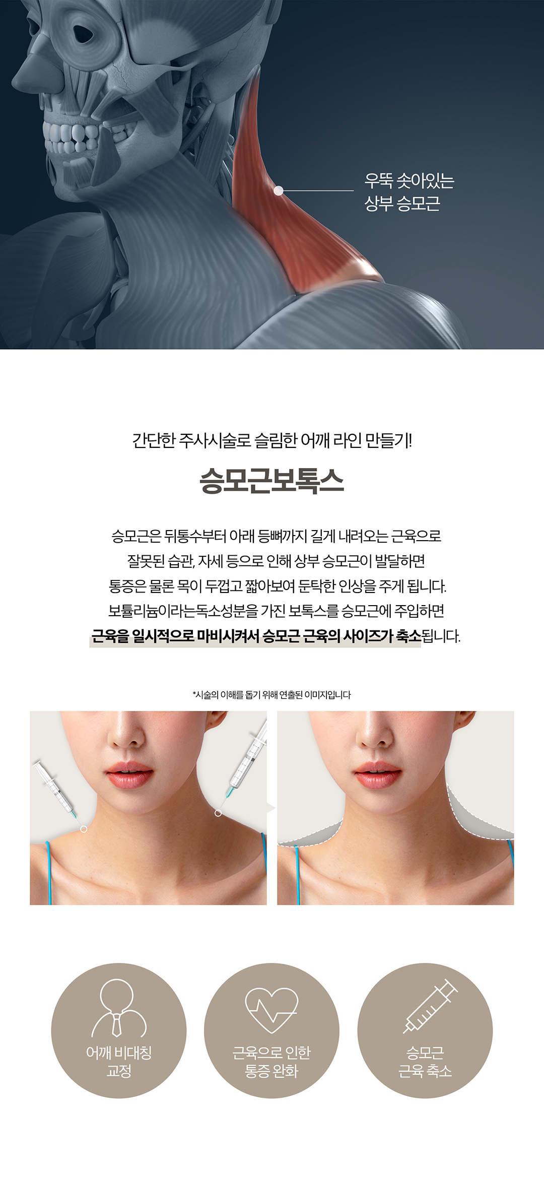 승모근보톡스 , 종아리보톡스로 날씬한 바디라인만들기
종아리보톡스
-다이어트로 빠지지 않았던 종아리알을 수술 없이 빠르게 해결
-가늘고 긴바늘을 사용하며 지방이 펴질 수 있도록 강하게 눌러서 근육까지 주입
승모근보톡스
-보튤리늄 성분을 승모근에 주입하여 근육을 일시적으로 마비시켜서 승모근 근육 사이즈 축소
-근육으로 인한 통증이나 어깨 비대칭 교정