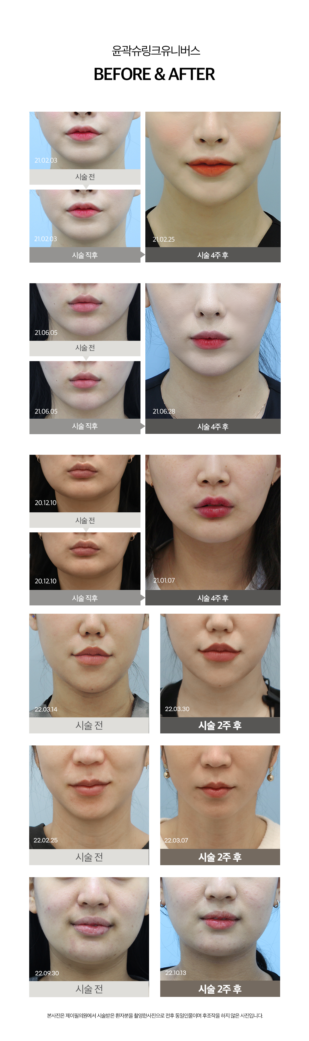 처진 얼굴형 고민을 이중턱or사각턱으로 나눠
얼굴살은 슈링크유니버스로 끌어올리고 고민유형에 맞는 솔루션 제공

- 슈링크 유니버스의 초음파 에너지로 근막부터 탄력개선
- 지방세포, 부종, 노폐물까지 배출하는 파워윤곽주사
- 정확한 근육위치에 주사해 발달한 근육을 줄여 갸름하게 만드는 근육보톡스
- 고민별 유형시술로 V라인 시너지 효과