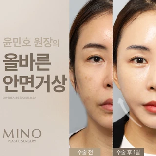 미노_올바른 안면거상