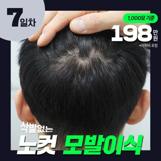 비절개 무삭발 노컷 모발이식 1000모