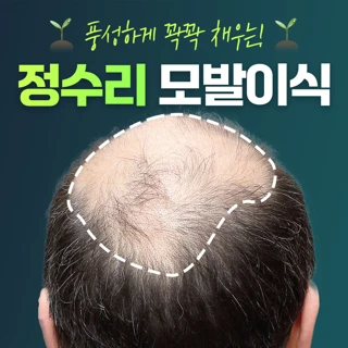 서진 풍성한 정수리 모발이식