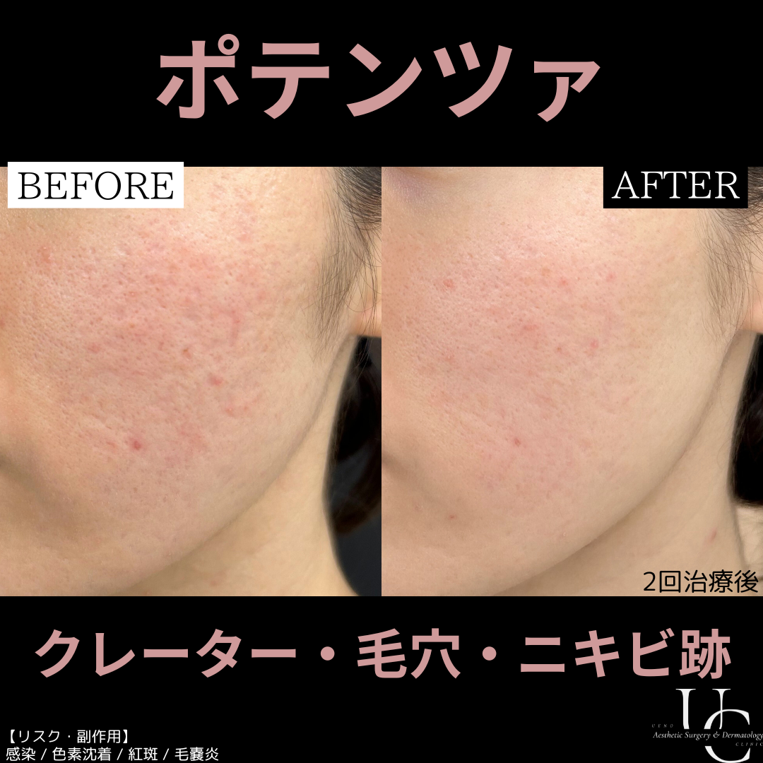 リジュランスキンブースター おすすめクリニック・値段の比較