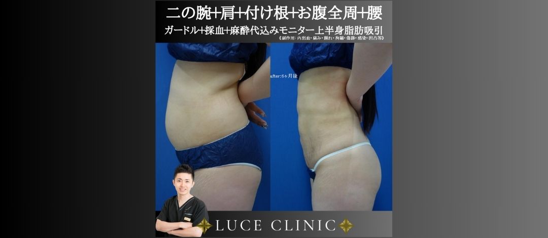 二の腕＆肩＆付け根＆お腹全周＆腰脂肪吸引 ガードル・採血・静脈麻酔