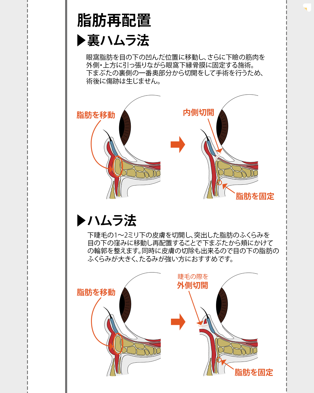 ※こちらのメニューは7月31日（木）までに施術を受けられた方限定の価格になります

▼eクリニックのクマ取り（脱脂法）について
脱脂法とは、目の下にできるふくらみを除去することで、クマや目の下のたるみを目立たせなくすることができる美容施術です。
脱脂法を行い、余分な眼窩脂肪を除去することで、目の周りをすっきりとさせ、若々しくハリのある目元を目指します。

▼脱脂法のメリット
・傷跡が残らない
・腫れや内出血が少ない
・ダウンタイムが短い
・効果が長持ちする


▼脂肪注入の併用について
脱脂のみでは目の下のボリュームが減少し、皮膚のたるみや窪みが強調されてしまう可能性がある場合は、併用での施術を行います。
脂肪注入をすることで、凹みや窪みを埋め、より自然な目元を目指します。

※医師が適応判断を行い、最適な治療をご提案させていただきますので、ご不安な方はカウンセリングの際に医師に直接お尋ねください。


【別途かかる費用】
・ダウンタイム軽減オプション代：¥55,000
・初診料：無料
・カウンセリング料：無料

【アフターケアについて】
ダウンタイムの過ごし方や注意事項などの詳細は、カウンセリング時にしっかりとお伝えさせていただきます。
当院は、術後のアフターケアに力を入れております。
ダウンタイム中に感じた不安点やトラブルなどは、すぐに対応いたします。
安心して受診・施術できるようスタッフが一丸となってサポートさせていただきますのでお気軽にご相談下さいませ。

【当日施術について】
当日の施術室の空き枠次第でご案内可能です。

【予約について】
ご予約のお申込みをしていだきましたら、クリニックからメールで確定のご連絡を差し上げます。

【未成年者のご来院について】
2022年4月より法改正に伴い18歳以上の方は、親権者の同伴が不要となります。18歳未満の方は、必ず親権者との同伴が必要になります。

【利用条件・モニターについて】
・SNSやHP等に全顔の掲載が可能な方
・施術前後に一定回数クリニックに通院し、ビフォー/アフターの撮影が可能な方


※非モニターの場合、通常価格でのご案内となります。
