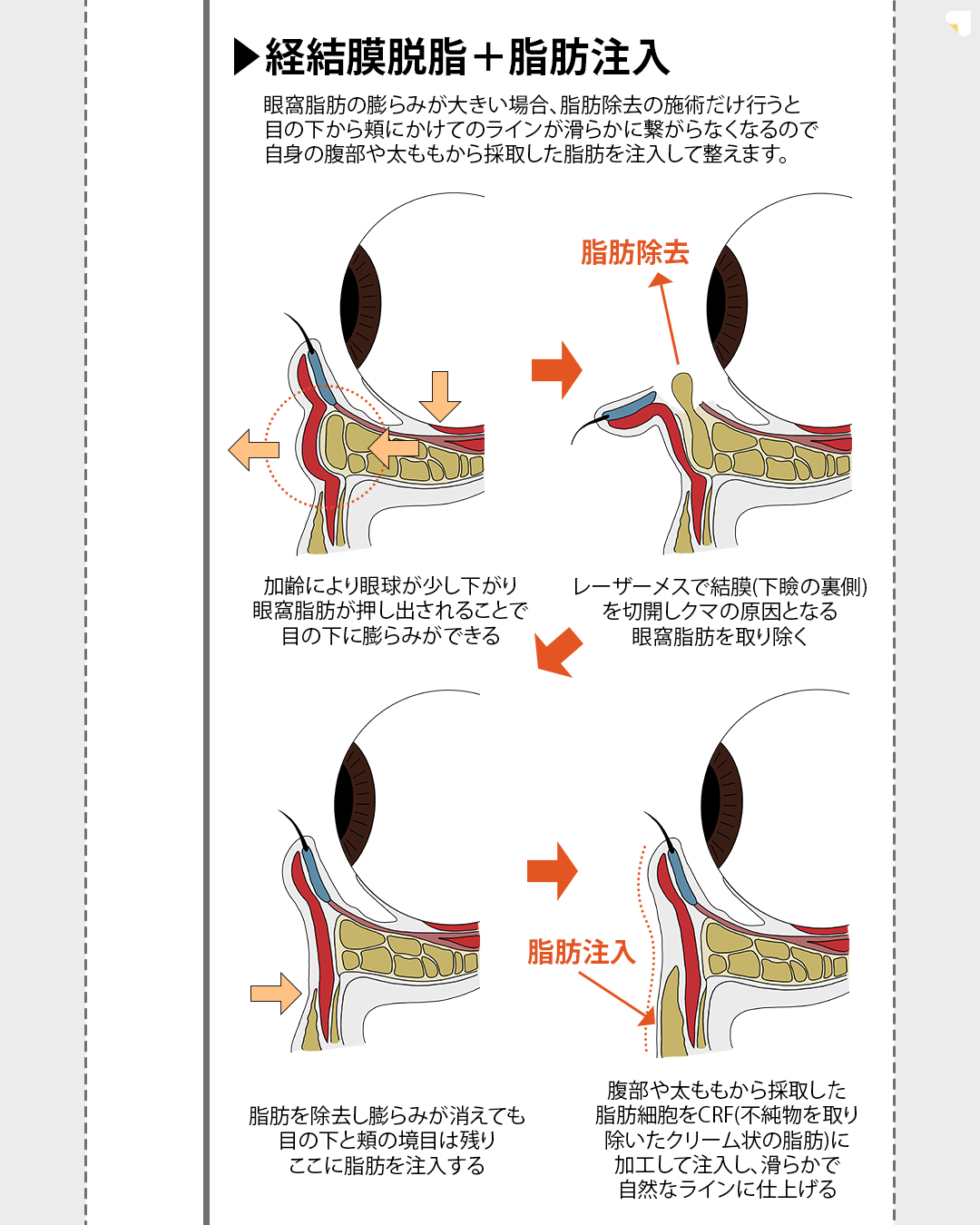 ※こちらのメニューは7月31日(木)までに施術を受けられた方限定の価格になります
▼eクリニックのクマ取り(脱脂法)について
脱脂法とは、目の下にできるふくらみを除去することで、クマや目の下のたるみを目立たせなくすることができる美容施術です。
脱脂法を行い、余分な眼窩脂肪を除去することで、目の周りをすっきりとさせ、若々しくハリのある目元を目指します。
▼脱脂法のメリット
・傷跡が残らない
・腫れや内出血が少ない
・ダウンタイムが短い
・効果が長持ちする
▼脂肪注入の併用について
脱脂のみでは目の下のボリュームが減少し、皮膚のたるみや窪みが強調されてしまう可能性がある場合は、併用での施術を行います。
脂肪注入をすることで、凹みや窪みを埋め、より自然な目元を目指します。
※医師が適応判断を行い、最適な治療をご提案させていただきますので、ご不安な方はカウンセリングの際に医師に直接お尋ねください。
【別途かかる費用】
・ダウンタイム軽減オプション代:¥55,000
・初診料:無料
・カウンセリング料:無料
【アフターケアについて】
ダウンタイムの過ごし方や注意事項などの詳細は、カウンセリング時にしっかりとお伝えさせていただきます。
当院は、術後のアフターケアに力を入れております。
ダウンタイム中に感じた不安点やトラブルなどは、すぐに対応いたします。
安心して受診・施術できるようスタッフが一丸となってサポートさせていただきますのでお気軽にご相談下さいませ。
【当日施術について】
当日の施術室の空き枠次第でご案内可能です。
【予約について】
ご予約のお申込みをしていだきましたら、クリニックからメールで確定のご連絡を差し上げます。
【未成年者のご来院について】
2022年4月より法改正に伴い18歳以上の方は、親権者の同伴が不要となります。18歳未満の方は、必ず親権者との同伴が必要になります。
【利用条件・モニターについて】
・SNSやHP等に全顔の掲載が可能な方
・施術前後に一定回数クリニックに通院し、ビフォー/アフターの撮影が可能な方
※非モニターの場合、通常価格でのご案内となります。
