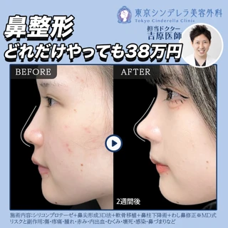 どれだけやっても38万円|どの角度から見ても美しい美鼻に!