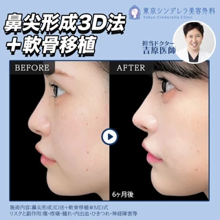 鼻尖形成3D法+軟骨移植|鼻先フルセット