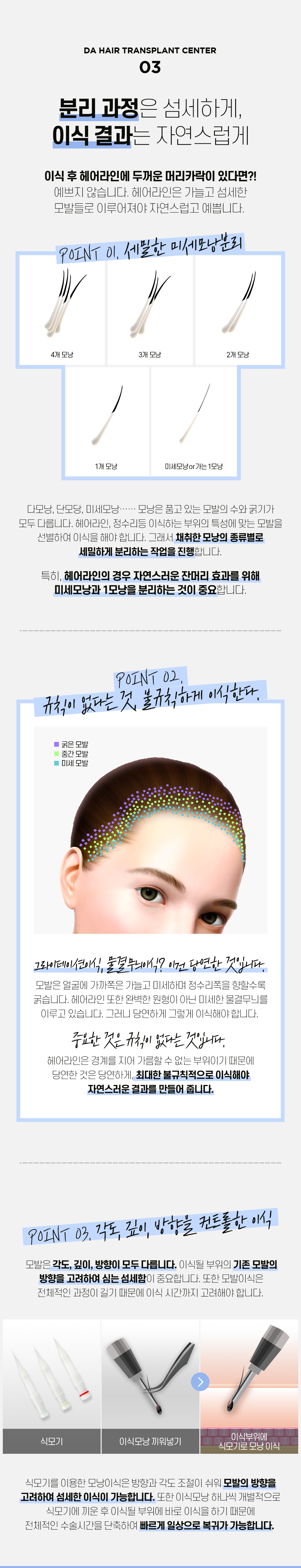 예쁜 얼굴형의 완성, 디에이 여성 헤어라인 모발이식 비절개 500모