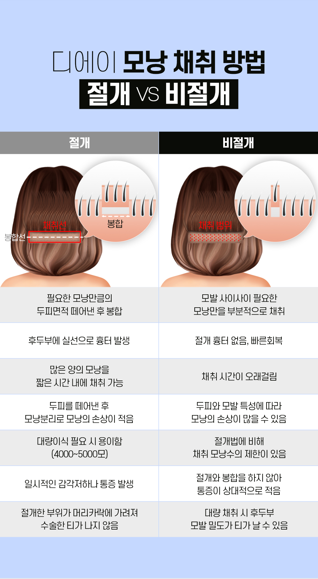예쁜 얼굴형의 완성, 디에이 여성 헤어라인 모발이식 비절개 500모
