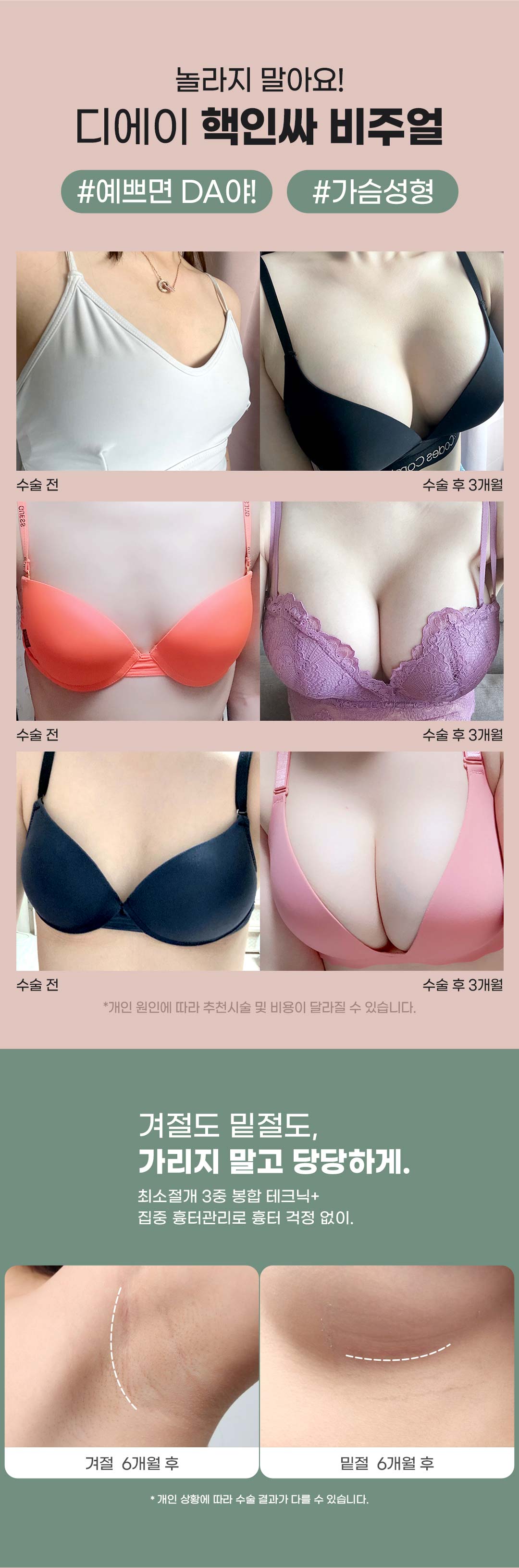 보형물 실리콘, 외피까지 FDA 승인된 안전한 가슴보형물. 모양과 안전까지 생각한 디에이 멘토가슴성형