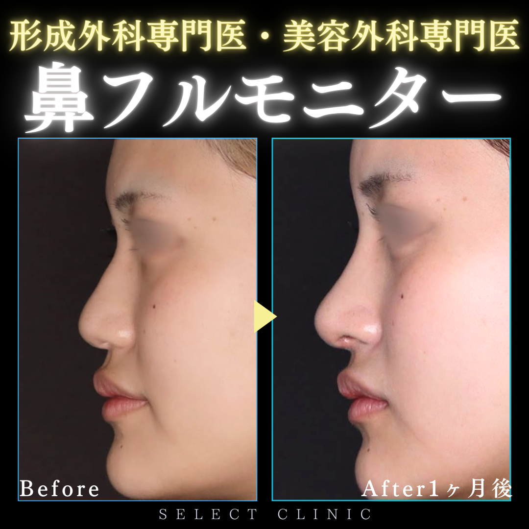 形成外科専門医】鼻フルセットモニター | SELECT CLINIC 大阪茶屋町院