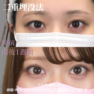 二重埋没法(2点留め)