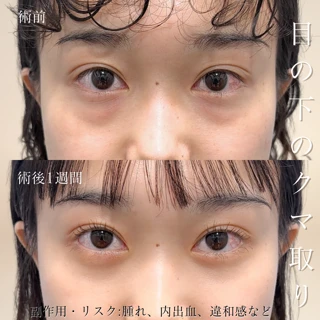 切らない目の下のクマ・たるみ取り(経結膜脱脂法)