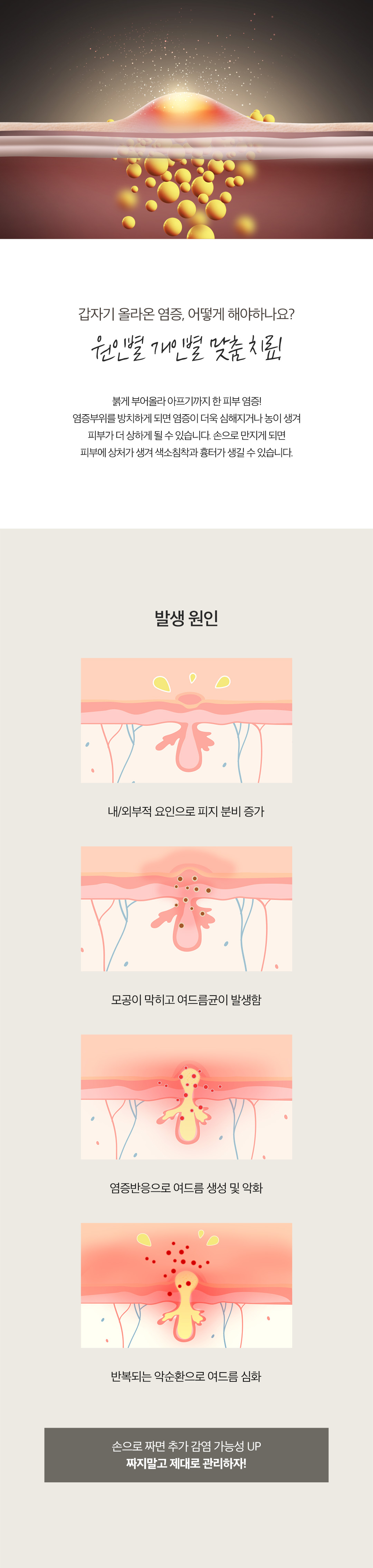 제이필 염증주사로 갑자기 생긴 트러블, 여드름 미리 관리하기
손으로 만지면 피부에 상처가 생겨서 색소침착과 흉터가 생길 수 있어서 염증 주사가 필요
- 갑자기 생긴뾰루지나 화농성 여드름에 직접 주사하여 항염작용을 통해 빠르게 염증 가라앉힘
- 추가 감염 예방 및 상처 흉터 걱정 DOWN