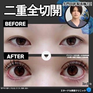二重全切開(眼瞼下垂併用可)
