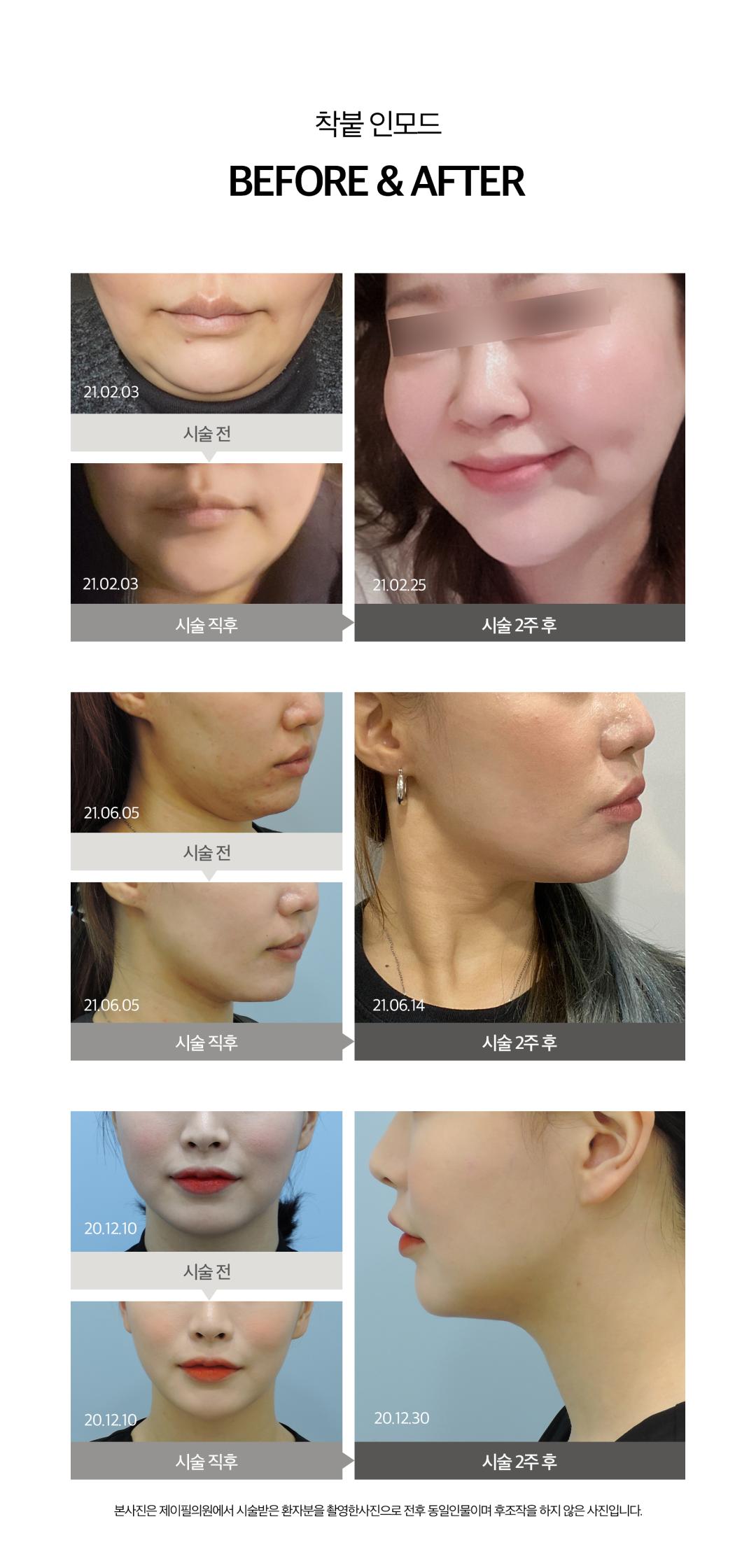 고주파 RF 에너지를 특허받은 기술을 통해
불필요한 지방을 파괴하고 지방이 빠진자리의 탄력을 끌어올려
V라인을 만드는 지방파괴 리프팅
-HVP 기술로 지방층까지 제대로된 에너지전달
-지방파괴&리프팅&콜라겐재생을 한번에