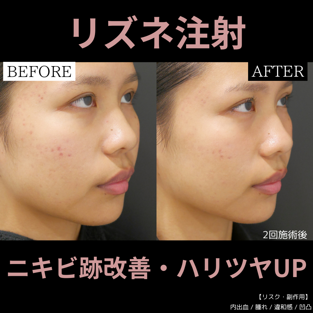 リジュラン　トーンアップブースター　ダーマペン リジュラン トーンアップブースター ダーマペン