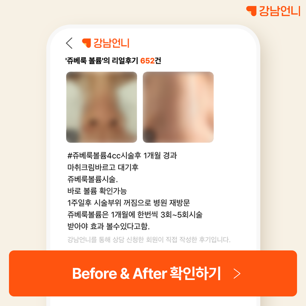 쥬베룩 볼륨, 팔자주름에 진짜 효과 있을까? 후기, 가격