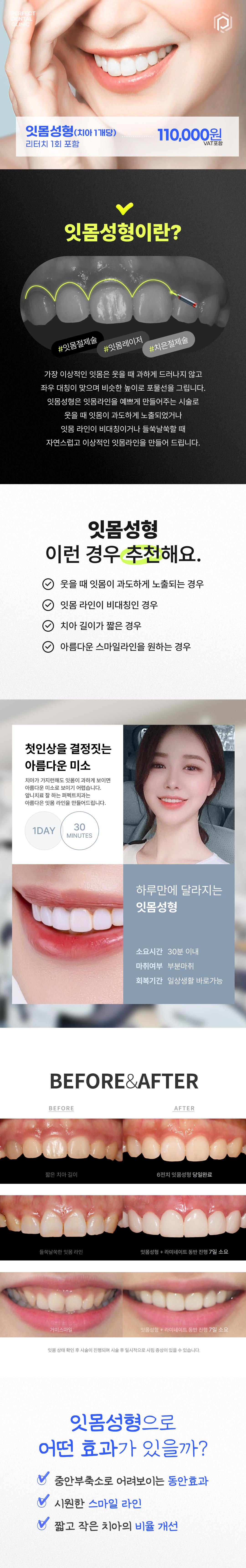 거미스마일, 잇몸비대칭, 짧은 치아 하루만에 해결